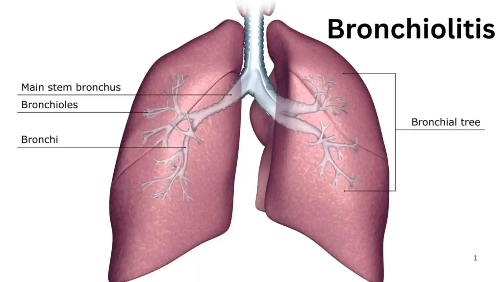 What Is Bronchiolitis?