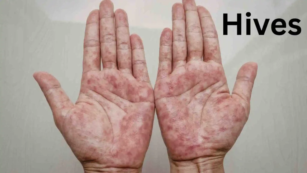 What Are Hives?
